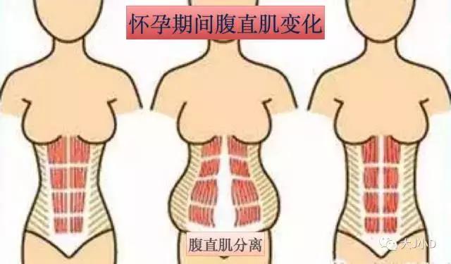 你的腹直肌分離了嗎？