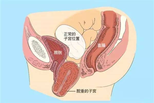 【產后修復】盆腔臟器脫垂，你有嗎？