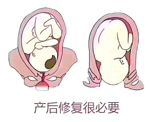 產后恢復項目好不好，兩大指標尤為關鍵