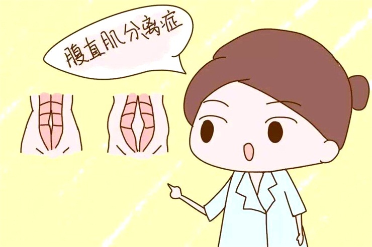 腹直肌分離問題，產后康復治療儀幫助您