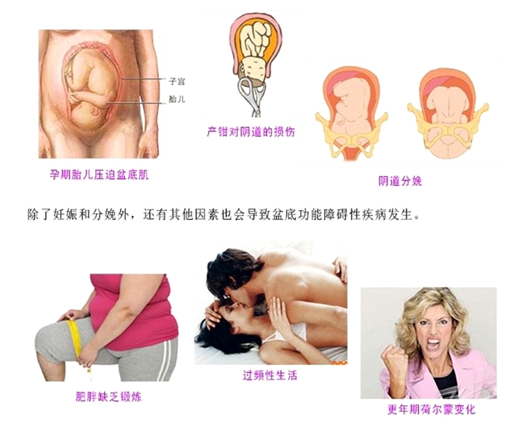 產后康復治療很重要，慢性盆腔痛很重要
