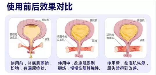 盆底康復治療怎么做？產后盆底功能檢測很重要