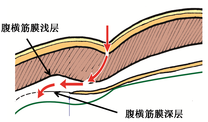 產后腹直肌分離如何康復，腹直肌修復那點事
