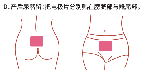 產后康復治療儀/仿生物電刺激治療產后尿潴留效果怎么樣？