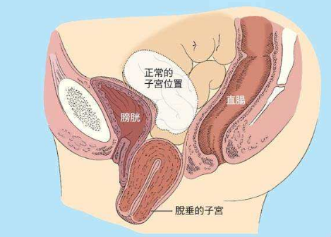 人們常說，產后女性做好盆底肌修復是關鍵，但盆腔器官的脫垂你也得注意