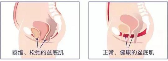 尿失禁治療儀器，不再詢問盆底康復治療有用嗎這類無意義問題