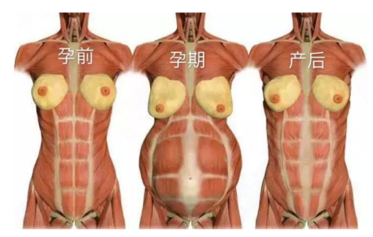 產婦不要隨意大吃大喝，腹直肌分離修復不太容易