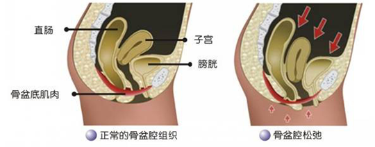 盆底功能檢測很重要，盆底肌松弛了會有什么表現呢？