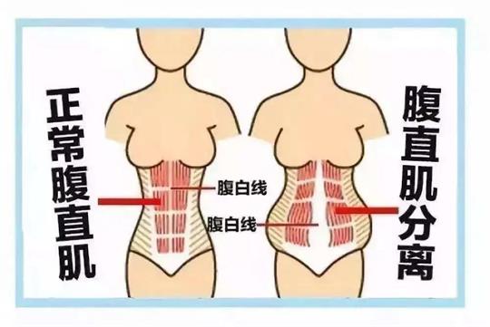 你所不知道的產后腹直肌如何康復，通澤產康為您解答