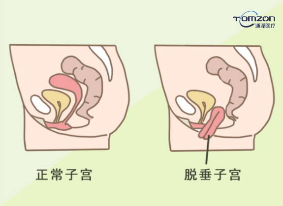你害怕子宮脫垂嗎？盆底肌修復儀器來拯救你