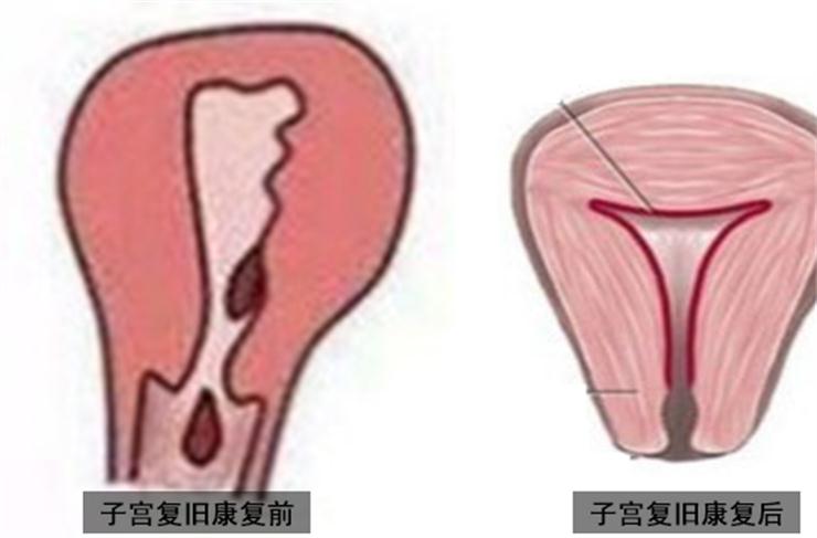 產后盆底修復