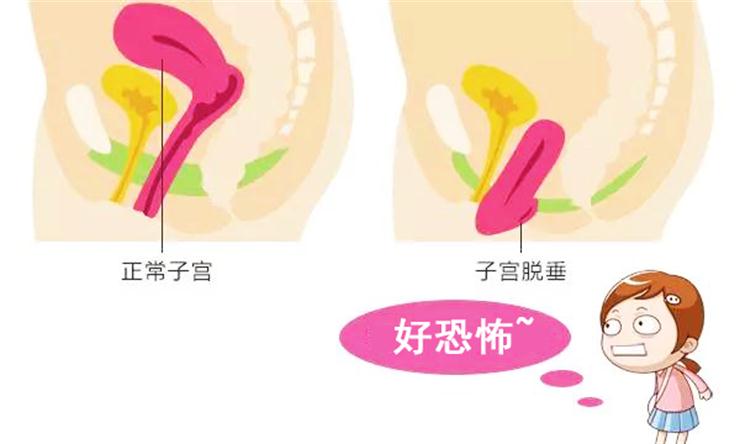 產后盆底肌修復