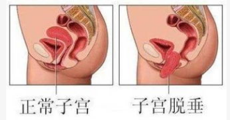 產后康復治療