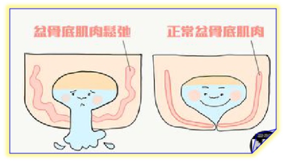 產后盆底康復
